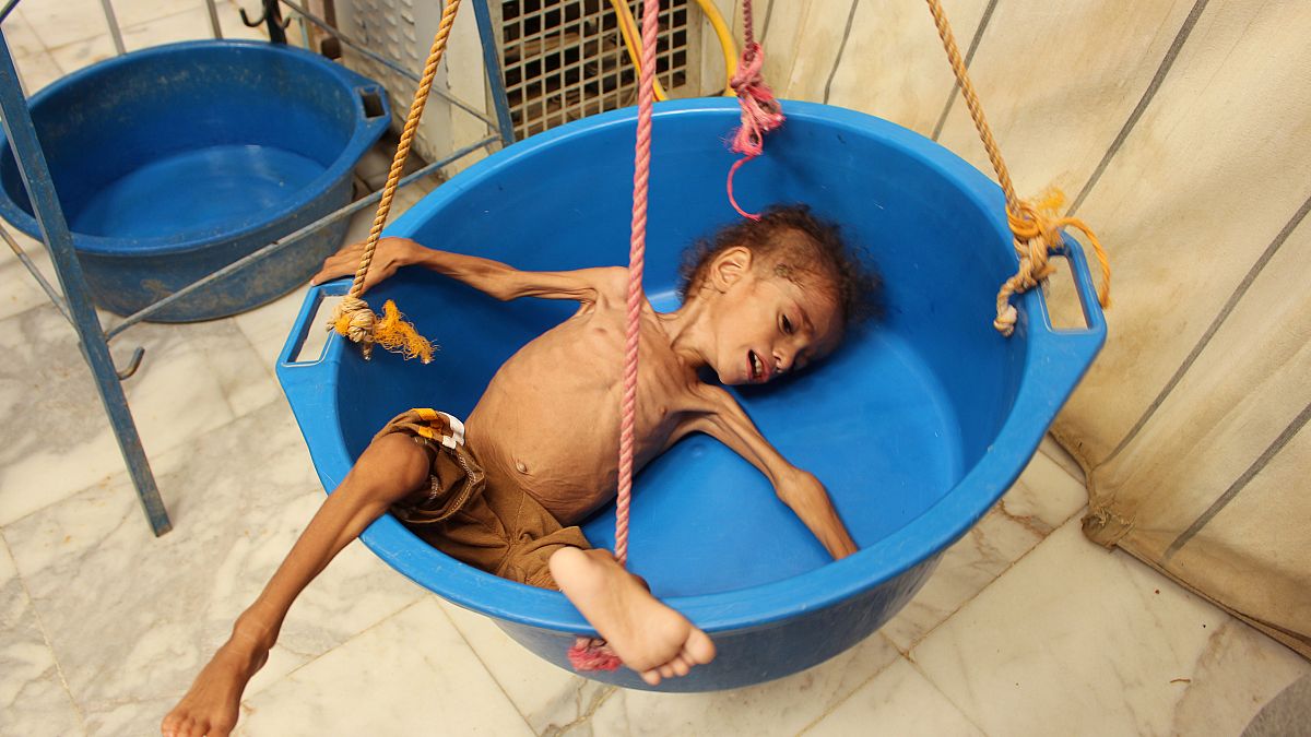 Yemen'de muayene öncesi hastanede tartıya alınan bir çocuk