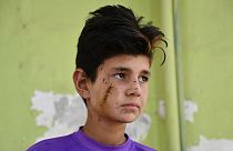 تمیم، پسربچه ۱۲ ساله از باشندگان پلخمری افغانستان که بر اثر انفجار مجروح شد