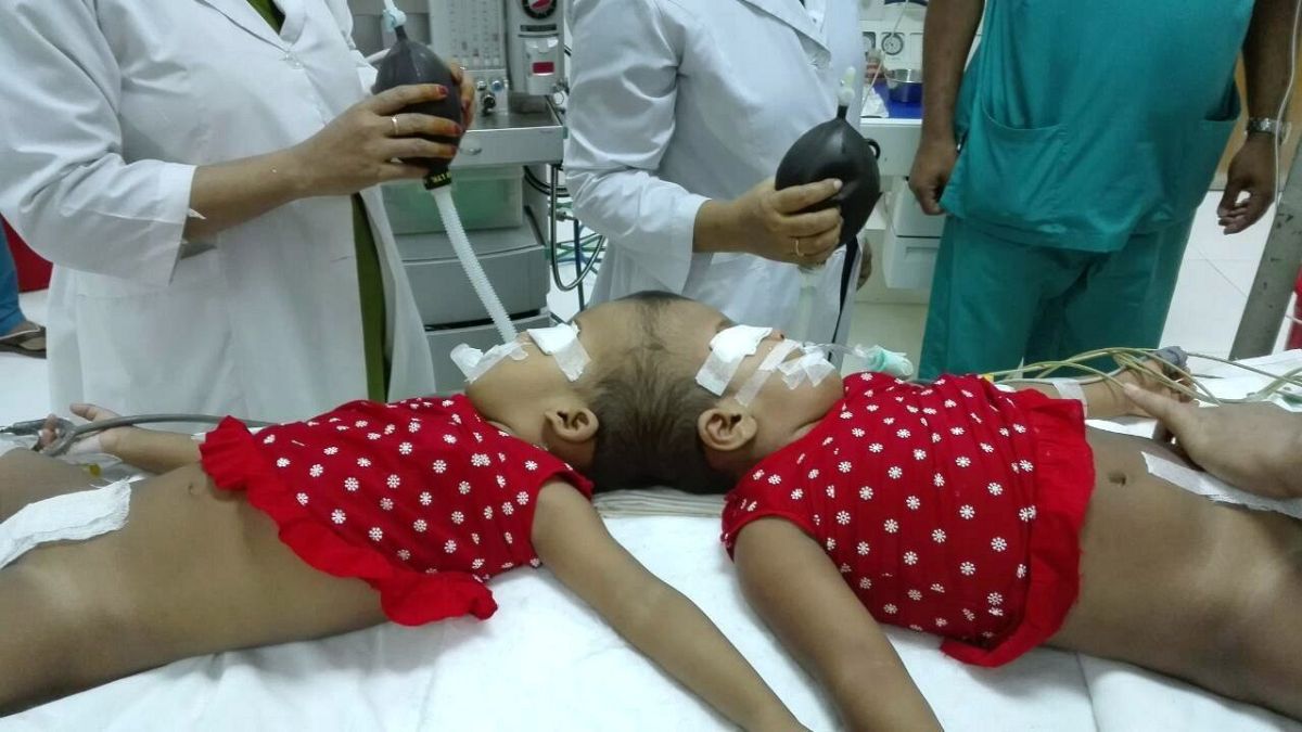 Stabil az állapota a bangladesi kislánynak, akit magyar orvosok választottak el sziámi testvérétől 