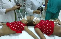 Stabil az állapota a bangladesi kislánynak, akit magyar orvosok választottak el sziámi testvérétől