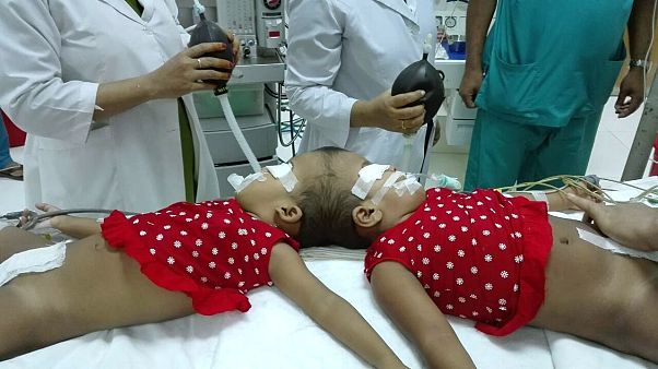 Stabil az állapota a bangladesi kislánynak, akit magyar orvosok választottak el sziámi testvérétől Stabil az állapota a bangladesi kislánynak, akit magyar orvosok választottak el sziámi testvérétől