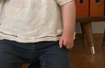 Fehlgebildete Hand eines Kindes