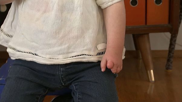 Fehlgebildete Hand eines Kindes Fehlgebildete Hand eines Kindes
