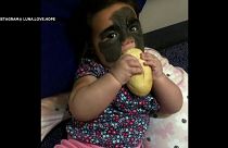 Ρωσία: Θεραπεία για την 6 μηνών Λούνα που γεννήθηκε με μαύρο σημάδι στο πρόσωπο