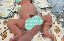 Rusya'da üç bacaklı, iki penisli bebek dünyaya geldi