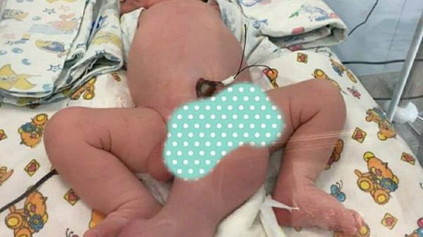 Rusya'da üç bacaklı, iki penisli bebek dünyaya geldi Rusya'da üç bacaklı, iki penisli bebek dünyaya geldi