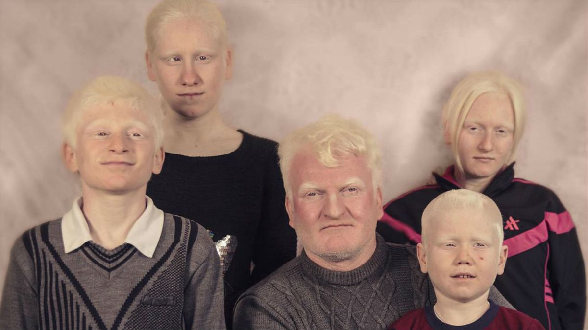 Türkiye'nin Albino çocukları: Eğitimden sağlığa sorunlar zinciri