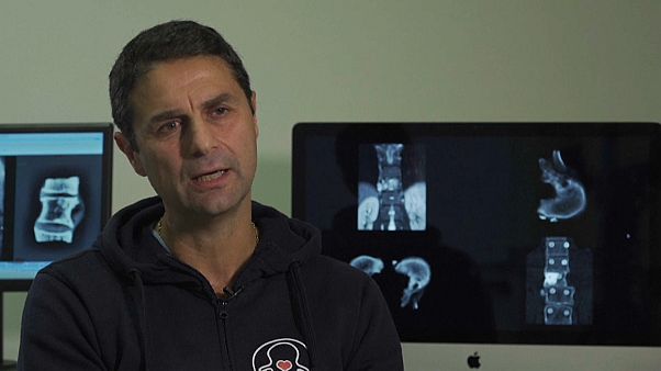 Primo trapianto mondiale di vertebre. Nuovo record del Rizzoli Primo trapianto mondiale di vertebre. Nuovo record del Rizzoli