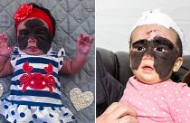 Мама Луны, родившейся с "маской Бэтмена", показала результаты первой операции