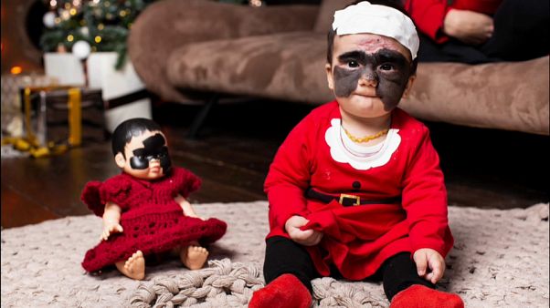 Kind mit "Batman-Maske": Luna aus Florida in Russland behandelt Kind mit "Batman-Maske": Luna aus Florida in Russland behandelt