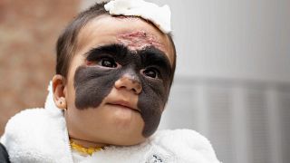 A bebé super-heroína que nasceu com a "máscara do Batman"