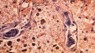 Bilim adamları bazı tümörlerin içinde kanserle savaşan hücreler buldu