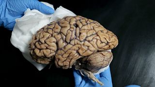 Um dos 60 exemplares armazenados no Banco de Cérebros Humanos
