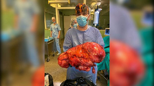 Letonya'da bir kanser hastasından 15 kg'lık timör çıkartıldı Letonya'da bir kanser hastasından 15 kg'lık timör çıkartıldı