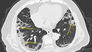 صورة عن طريق الأشعة لرئتي رجل مصاب في الصين بفيروس كوفيد-19 - مارس 2020