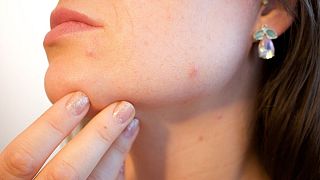 متخصصان: آسیب‌های پوستی از علائم احتمالی ابتلا به کرونا است