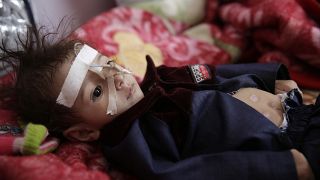 طفل يعاني من سوء التغذية، ينتظر تلقي العلاج في مستشفى السبعين في صنعاء، اليمن.