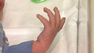 Выздоровел младенец, родившийся с коронавирусом