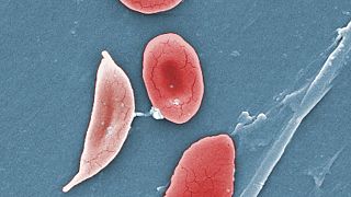 Bir orak hücreli anemi hastasının kan hücreleri örneği