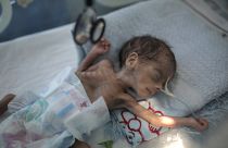 طفل حديث الولادة يعاني من سوء التغذية في حاضنة في مستشفى في صنعاء، اليمن. 
