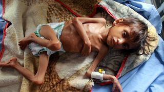 طفل يمني يعاني من سوء التغذية