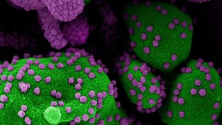 2020. július 2. Az amerikai Allergiás és Fertőző Betegségek Országos Intézetében (NIAID) készült delektronmikroszkópos, utószínezett kép SARS-CoV-2-vel fertőzött sejtekről