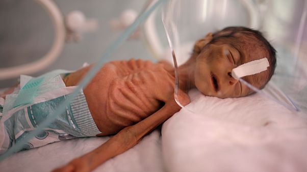 Yemen'deki savaş sebebiyle ortaya çıkan açlıkta iyi beslenememiş yeni doğmuş bir bebek Yemen'deki savaş sebebiyle ortaya çıkan açlıkta iyi beslenememiş yeni doğmuş bir bebek