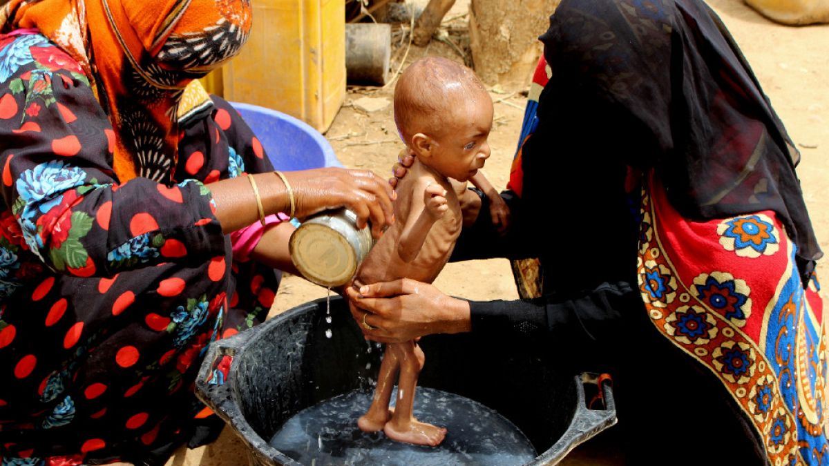 Un bambino malnutrito in Yemen
