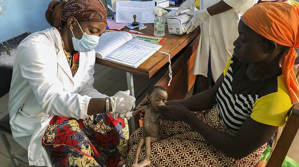 Burkina Faso'da yetersiz beslenmiş bir bebek tedavi olurken Burkina Faso'da yetersiz beslenmiş bir bebek tedavi olurken