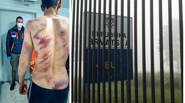 I segni delle brutalità sul corpo di un migrante intervistato dal Danish Refugee Council a Velika Kladusa, Bosnia: accusa la polizia croata di percosse e violenze I segni delle brutalità sul corpo di un migrante intervistato dal Danish Refugee Council a Velika Kladusa, Bosnia: accusa la polizia croata di percosse e violenze