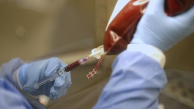 A blood bag with a bone marrow transplant is prepared. A blood bag with a bone marrow transplant is prepared.