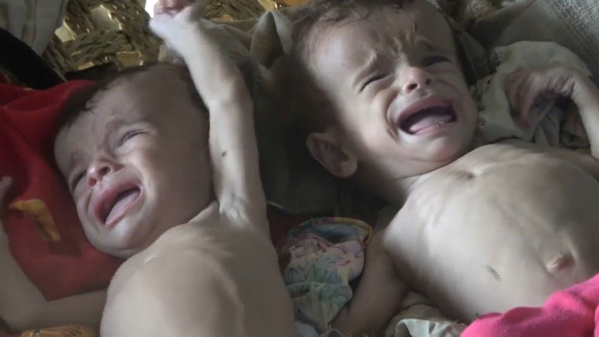 محمد وعلي توأم يمنيان مصابان بسوء التغذية