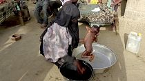 Un bambino malnutrito nello Yemen
