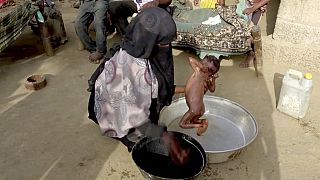 Un bambino malnutrito nello Yemen