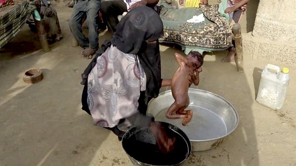 Un bambino malnutrito nello Yemen Un bambino malnutrito nello Yemen