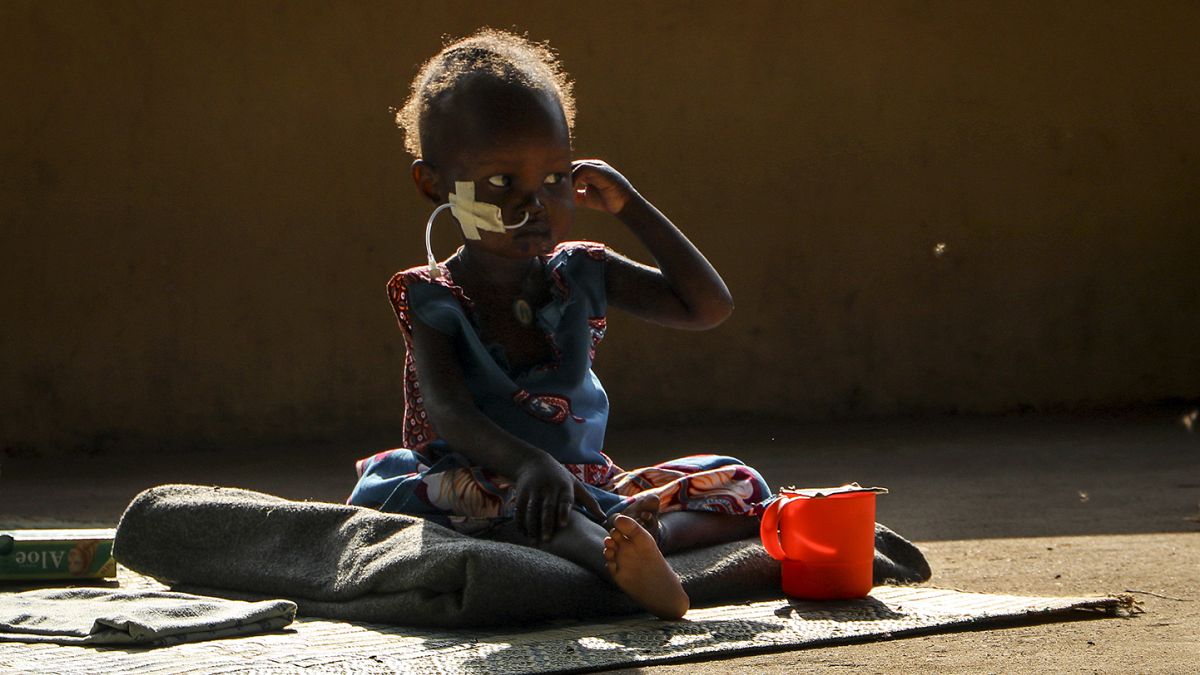 Yetersiz beslenme nedeniyle ödem şikayeti yaşayan 2 yaşındaki Akon Morro, tedavi gördüğü hastanenin bahçesinde otururken