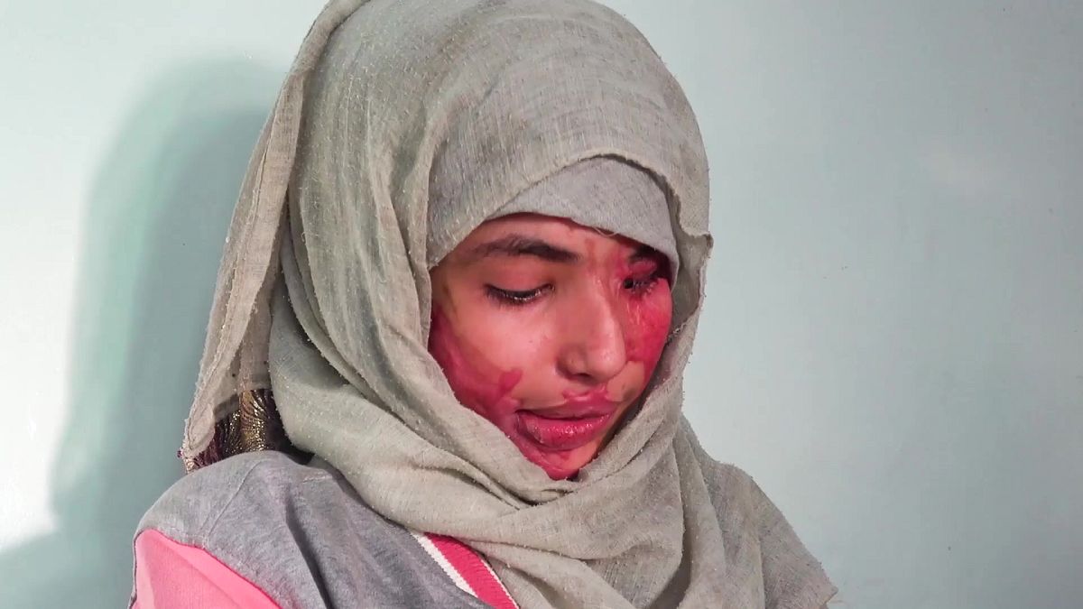 وجه الشابة العنود حسين شريان المشوه مرآة لمعاناة نساء اليمن من العنف والزواج المبكر