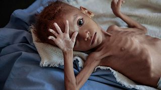 کودک قحطی زده یمنی