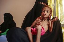 In this Oct. 1, 2018 file photo, a woman holds a malnourished boy at the Aslam Health Center, in Hajjah, Yemen