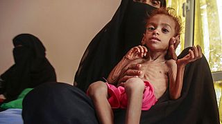 In this Oct. 1, 2018 file photo, a woman holds a malnourished boy at the Aslam Health Center, in Hajjah, Yemen