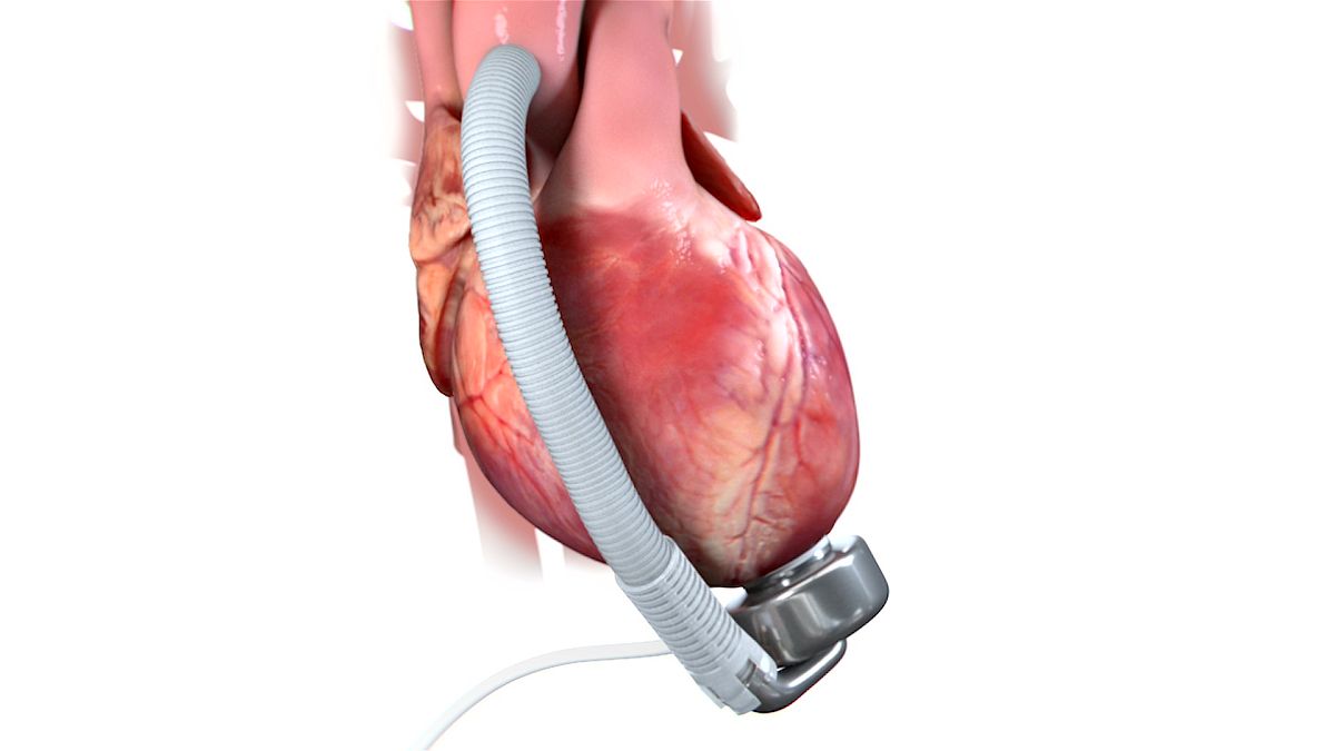 Corwave French medtech companies make breakthroughs in heart disease care ...