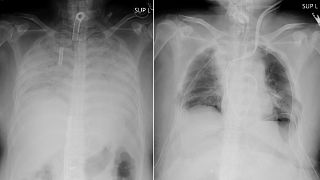 This combination of radiographs provided on April 9, 2021, by Kyoto University Hospital, shows the chest of a patient before the surgery, left, and after the surgery, right.