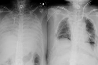 This combination of radiographs provided on April 9, 2021, by Kyoto University Hospital, shows the chest of a patient before the surgery, left, and after the surgery, right.
