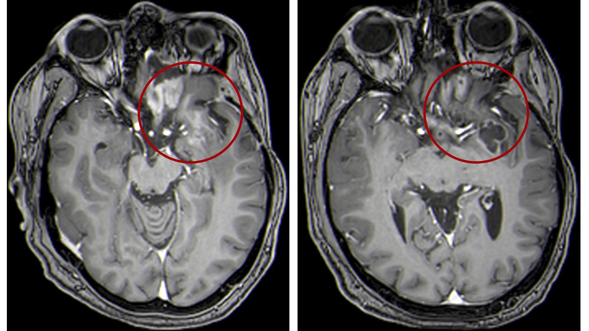 صورة بالرنين المغناطيسي للدماغ