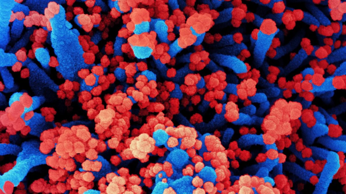 Elektronmikroszkópos kép koronavírussal erősen fertőzött emberi sejtekről 