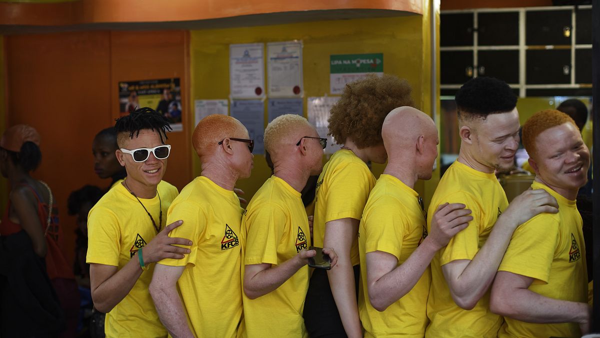 Június 13-a, az albinizmus világnapja