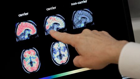 File photo of a doctor looking at an Alzheimer's PET scan. The NHS is trialling a new tool which they hope will help identify the disease in its early stages.