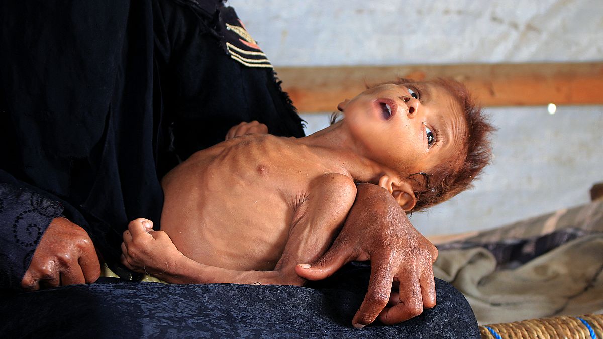 طفل يمني يبلغ من العمر أربع سنوات يزن تسعة كيلوغرامات بسبب سوء التغذية الحاد في محافظة حجة شمال اليمن في 2 مارس 2021.