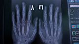 A photo of an X-ray of the electronic chips Russian doctor Aleksandr Volchek has implanted into his hands and wrist,