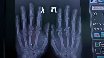 A photo of an X-ray of the electronic chips Russian doctor Aleksandr Volchek has implanted into his hands and wrist,